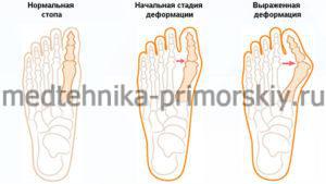 Степени деформации большого пальца ноги