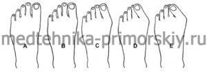 Развитие вальгусной деформации большого пальца ноги